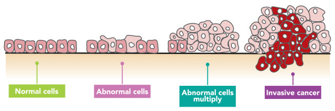 Cells changing from normal to cancerous